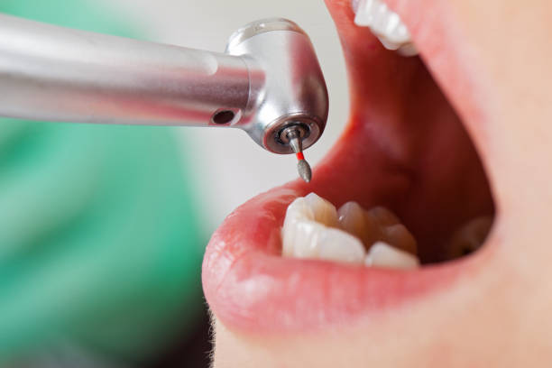 Best Emergency Wisdom Teeth Removal in Marquette Heights, IL